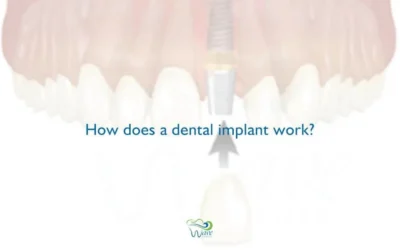 How Does A Dental Implant Work?