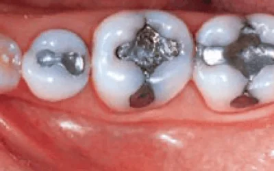 Should I Remove My Silver Fillings?