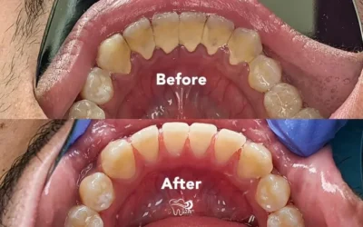 Before & After A Deep Cleaning