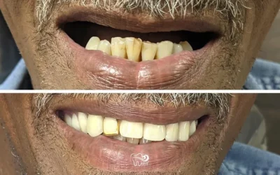 The Life-Changing Benefits of Dentures