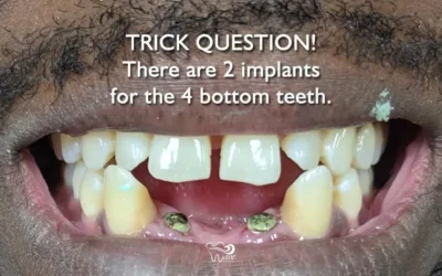 Can You Guess Which Tooth Is A Dental Implant?