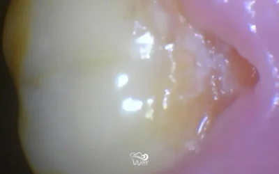 What Is Gum Recession?