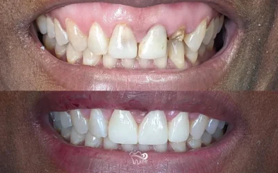 Before/After: Replacing Failing Crowns
