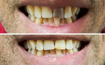 Rescuing a “Dead Tooth” with Internal Whitening