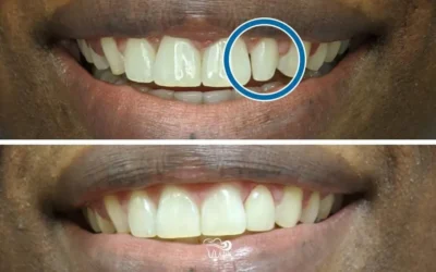 Peg Lateral: Incisors That Look Too Small