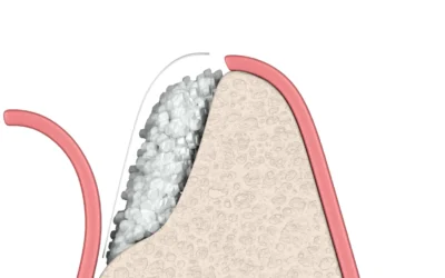 What Is A Ridge Augmentation?