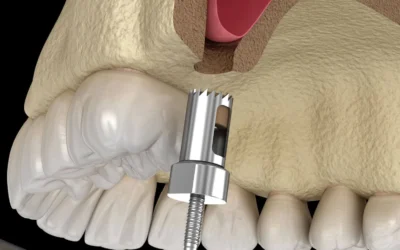 What is a Sinus Lift Procedure?