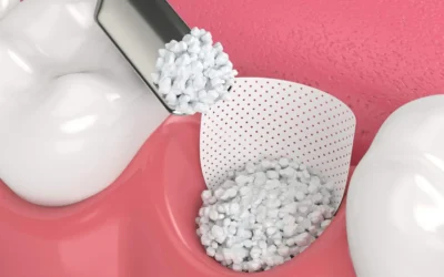 Is A Bone Graft Necessary After Tooth Extraction?
