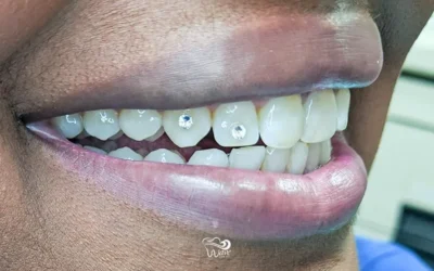 Add a Sparkle to Your Smile: Tooth Gems
