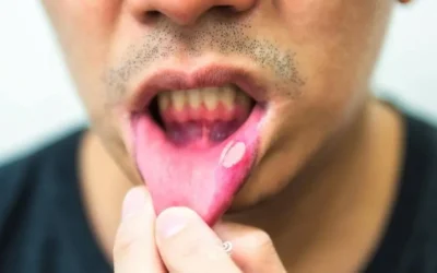 What Are Canker Sores? How Do You Treat Them?