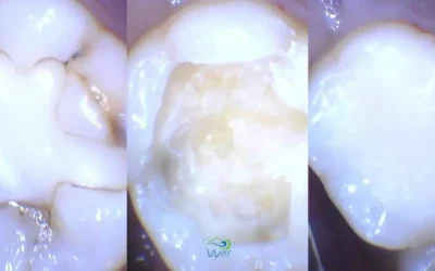 When Is It Time To Replace A Filling?